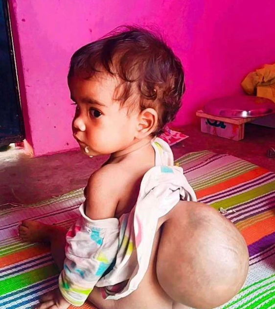 Gehna at home, the swelling on her lower back visible